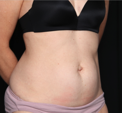 Tummy Tuck Before & After Patient #34911