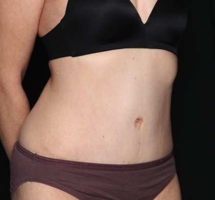 Tummy Tuck Before & After Patient #34911