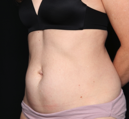 Tummy Tuck Before & After Patient #34911