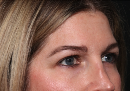 Brow Lift Before & After Patient #34929