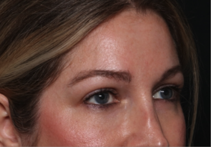 Brow Lift Before & After Patient #34929